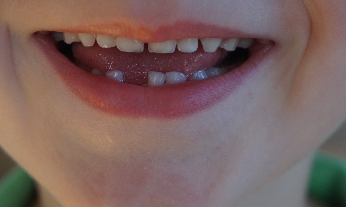 Tag der Zahnfee – Wie der Zahnschutz bei den Kleinsten aussieht